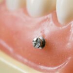 矯正用ミニインプラントを使った治療について