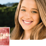 カリエールモーションを使用した矯正治療とは？