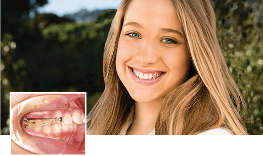 カリエールモーションを使用した矯正治療とは？