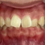 インビザライン治療　症例