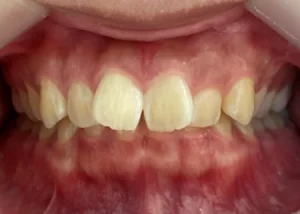 インビザライン治療　症例