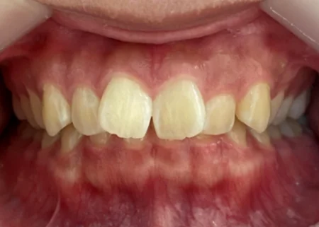 インビザライン治療　症例
