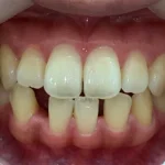 インビザライン治療　症例