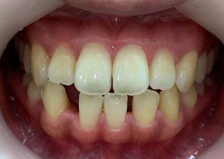 インビザライン治療 症例