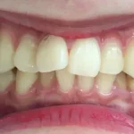 インビザライン治療　症例