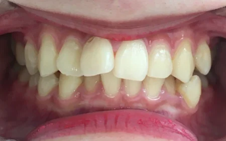 インビザライン治療　症例