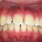 インビザライン治療　症例