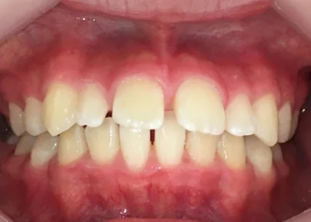 インビザライン治療 症例