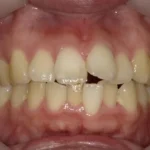 インビザライン治療　症例
