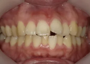 インビザライン治療　症例