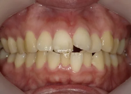 インビザライン治療　症例