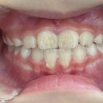 小児矯正　症例