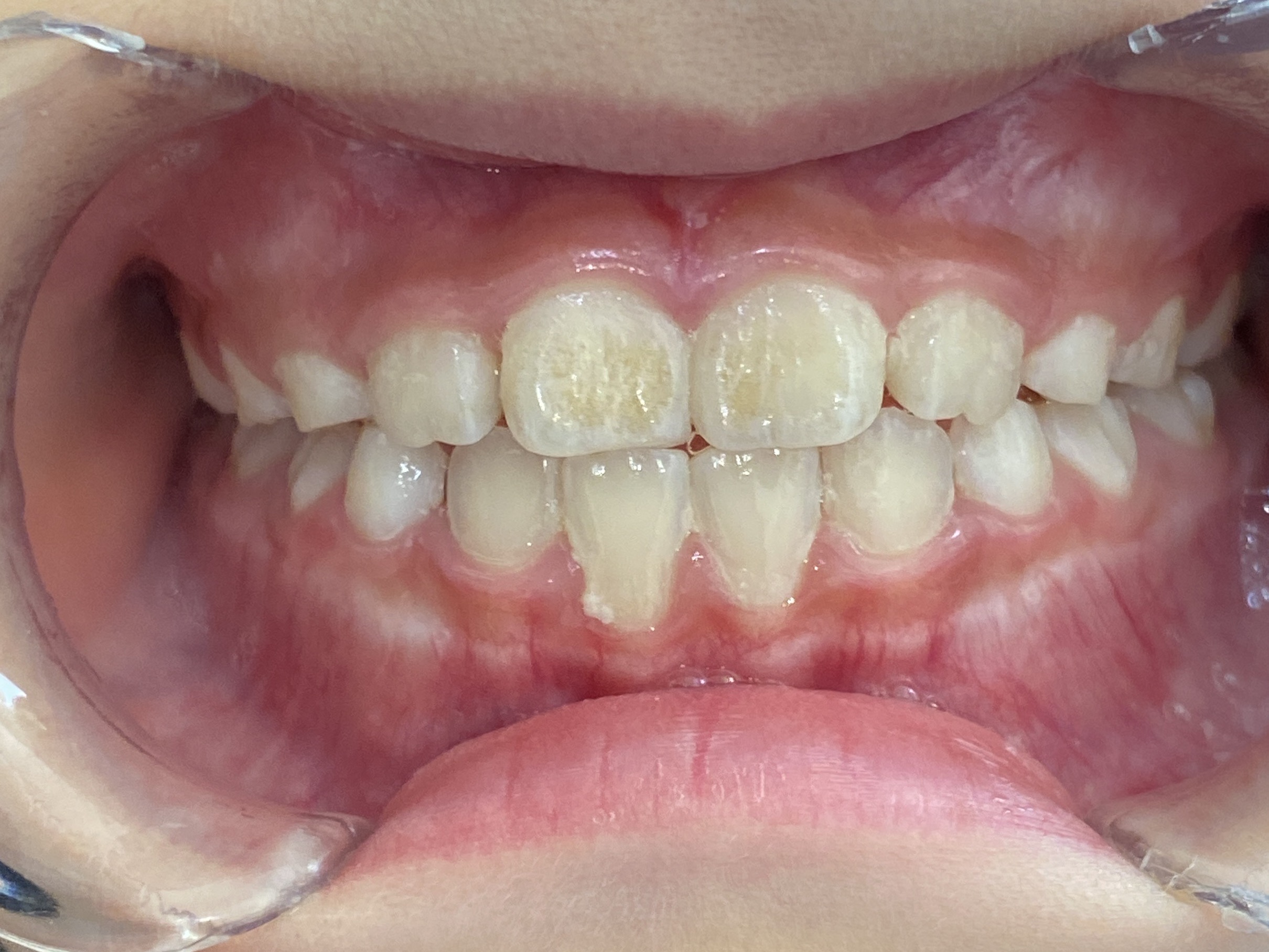 小児矯正　症例