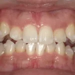ホワイトニング　症例