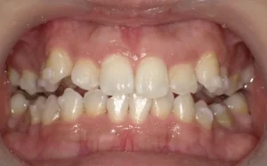 ホワイトニング　症例