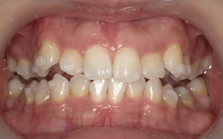 ホワイトニング　症例