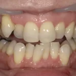 ホワイトニング　症例