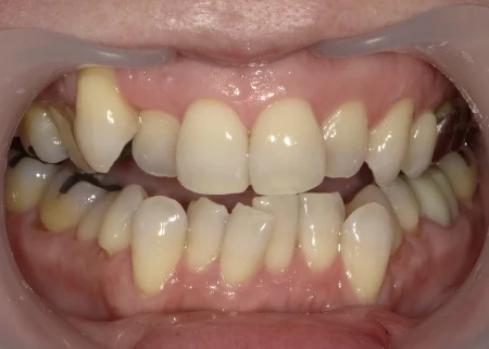 ホワイトニング 症例