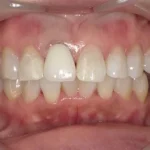 ホワイトニング　症例