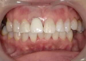 ホワイトニング　症例