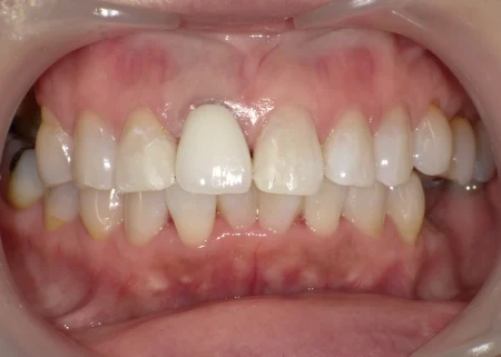 ホワイトニング 症例