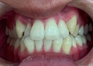 インビザライン治療　症例
