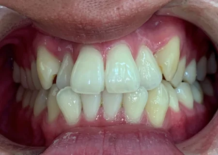 インビザライン治療 症例