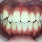 インビザライン治療　症例