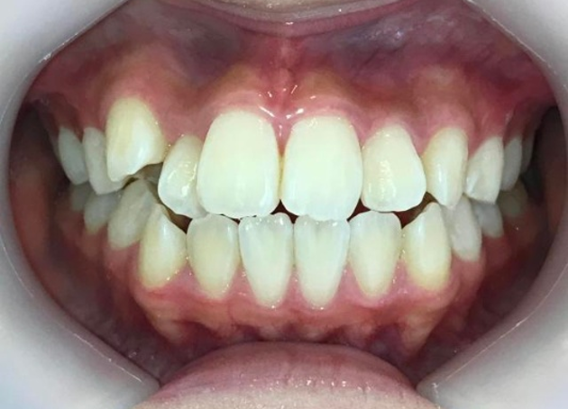 インビザライン治療　症例