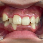 インビザライン治療　症例