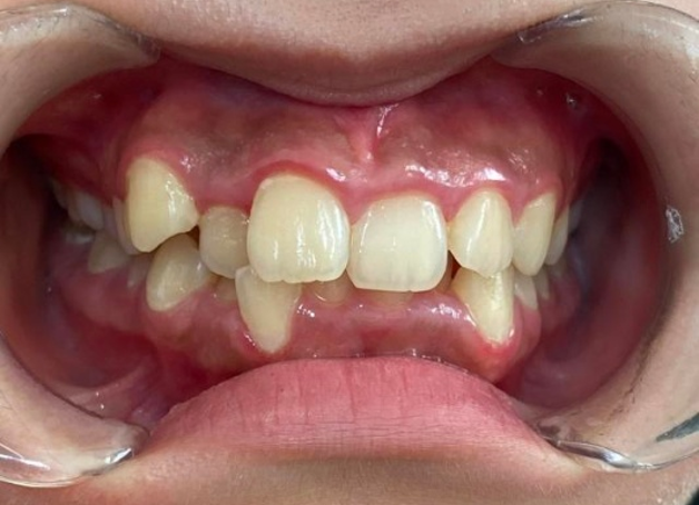 インビザライン治療 症例