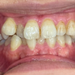 インビザライン治療　症例