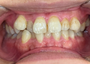 インビザライン治療　症例