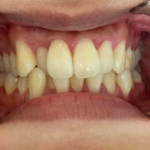 インビザライン治療　症例