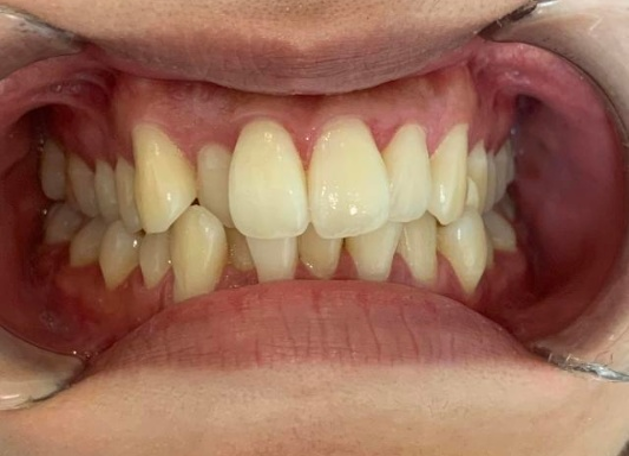 インビザライン治療 症例