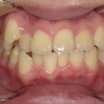 インビザライン治療　症例