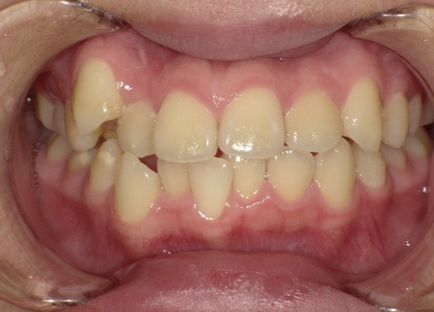 インビザライン治療 症例