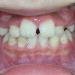 小児矯正　症例