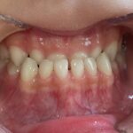 小児矯正　症例