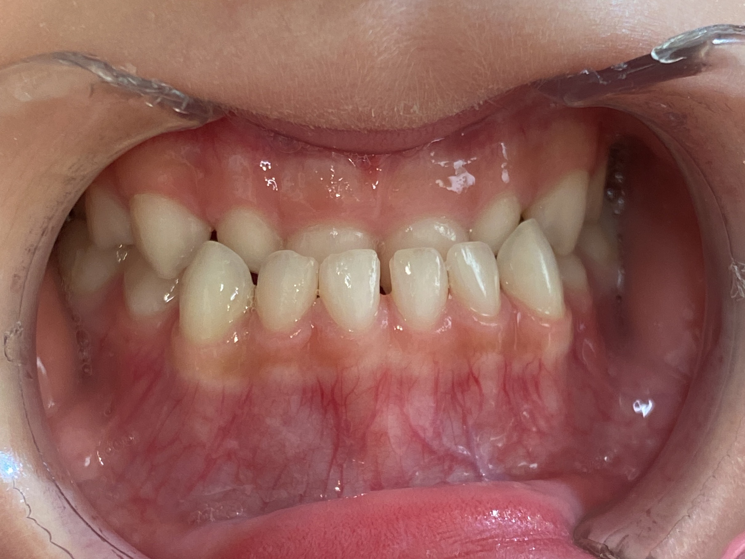 小児矯正　症例