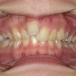 インビザライン治療　症例