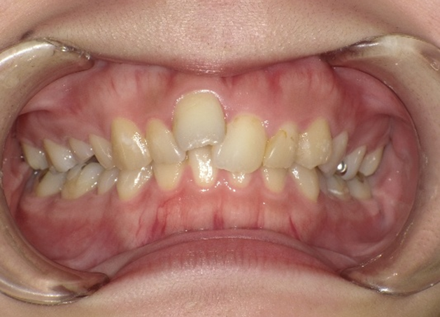 インビザライン治療 症例