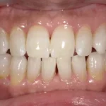 ホワイトニング　症例