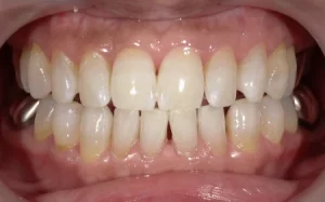 ホワイトニング　症例
