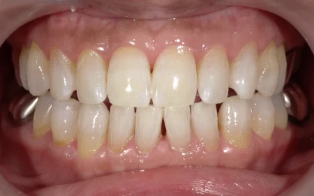 ホワイトニング　症例