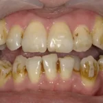 クリーニング　症例