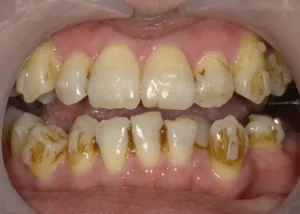 クリーニング　症例