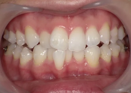 ホワイトニング　症例