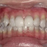 ホワイトニング　症例