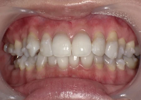 ホワイトニング　症例